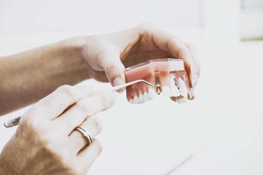 How Long Do Dentures Last? 