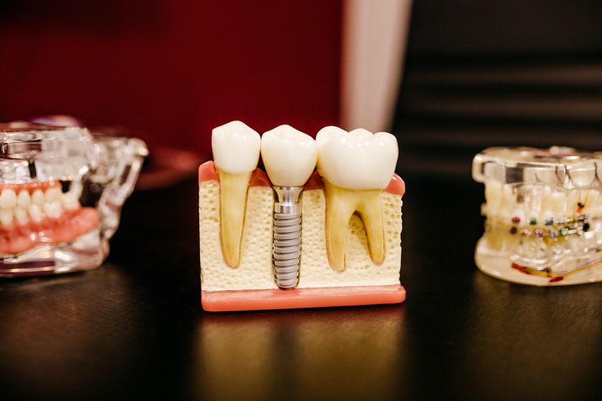 What financing options do I have for wisdom teeth removal near me?