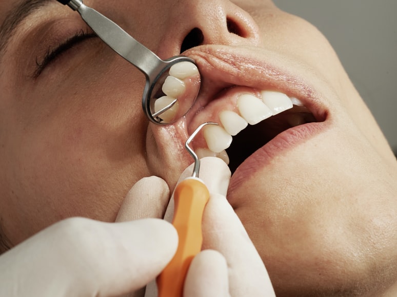 Why is wisdom tooth removal expensive?