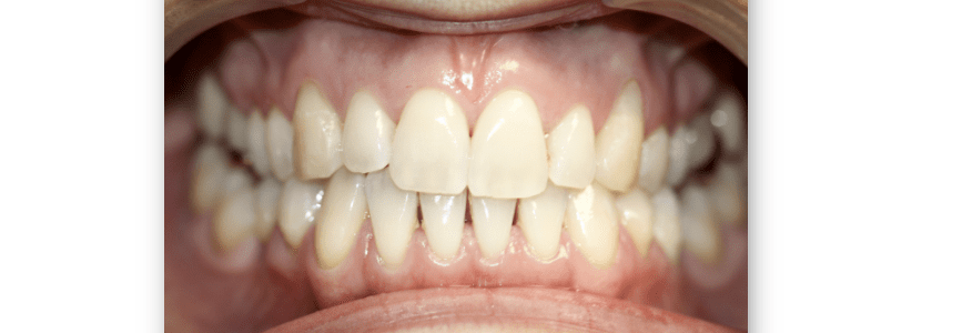 What Causes Black Triangle Teeth