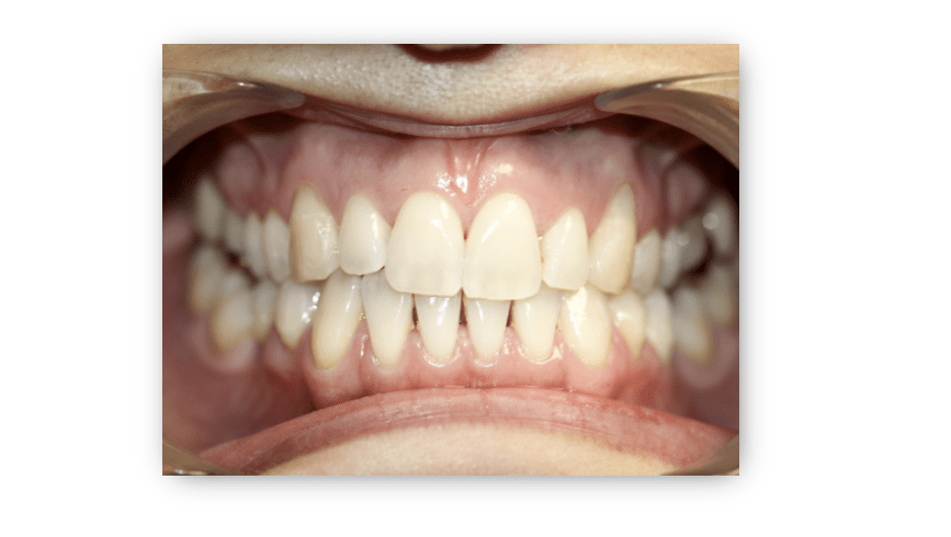 What Causes Black Triangle Teeth