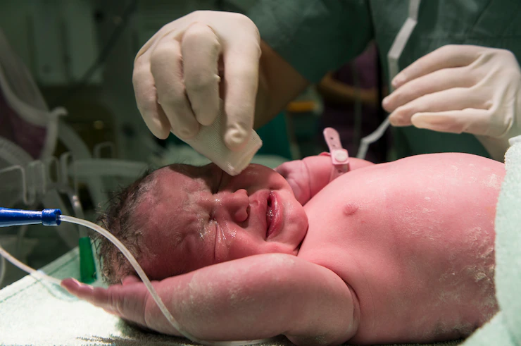 delivery of a newborn baby