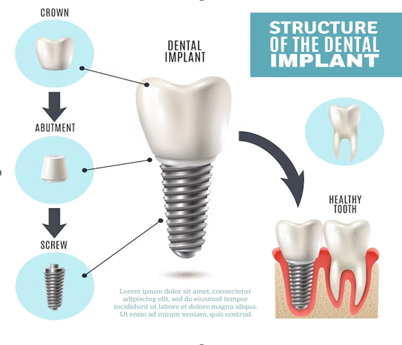 A Guide To Different Types Of Dental Implants
